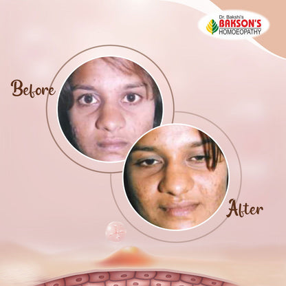Get Clear Skin with Bakson Homeopathy Acne Aid Cream - Homeopathy for Acne Control - Golden-Patel Son